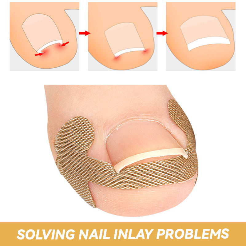 Nail Groove Ingrown Toenail Patch
