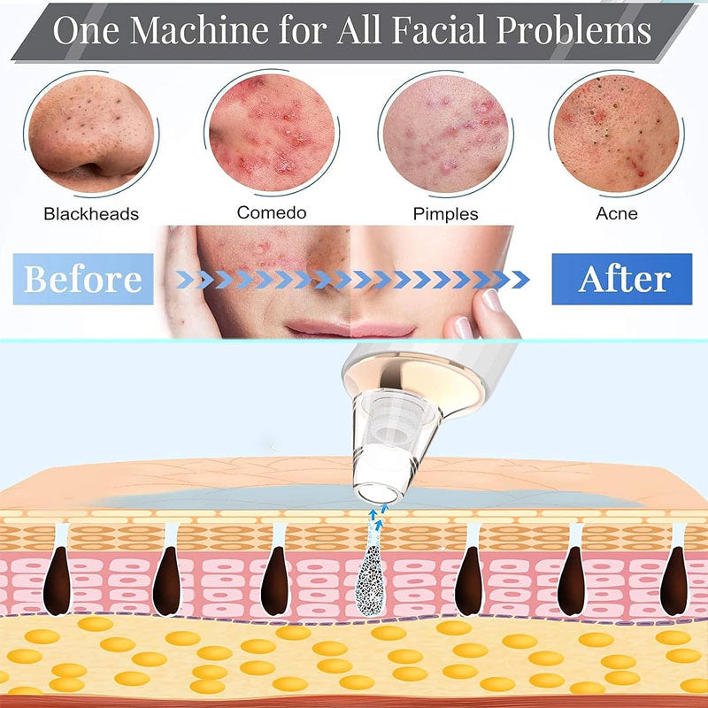 Vacuum Pore Cleaning Blackhead Device