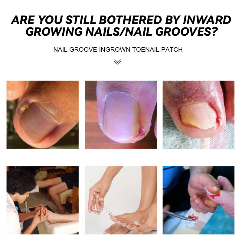 Nail Groove Ingrown Toenail Patch
