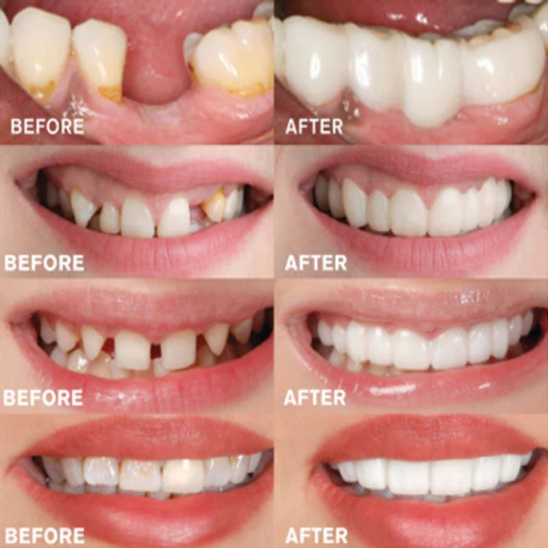 Snap on Smile Veneers