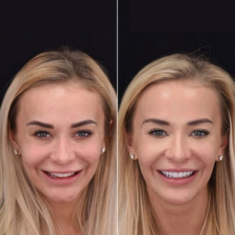 Snap on Smile Veneers