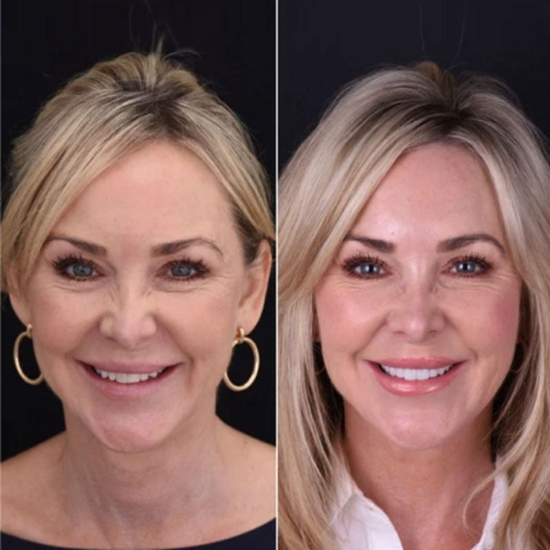 Snap on Smile Veneers