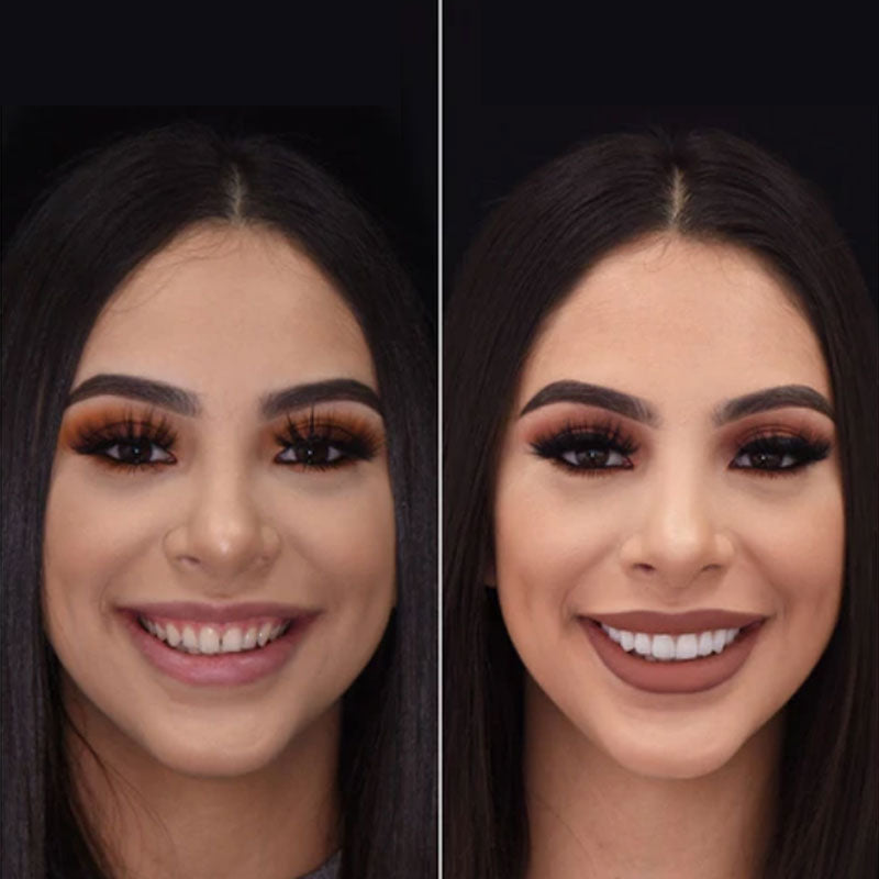 Snap on Smile Veneers