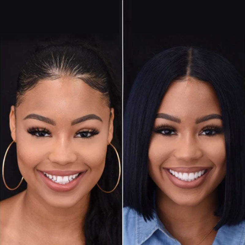 Snap on Smile Veneers