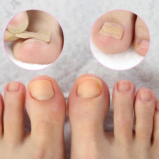 Toenail Correction Stickers