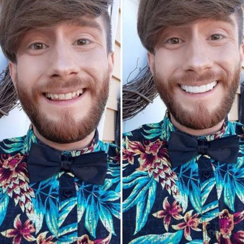 Snap on Smile Veneers