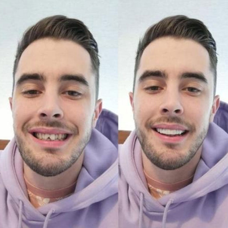 Snap on Smile Veneers