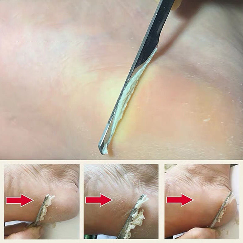 Stainless Steel Foot Scraper Knife to Remove Dead Skin Callus